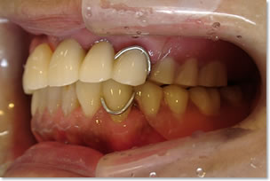 通常の義歯（入れ歯）