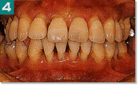 中等度歯周炎2