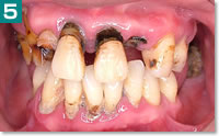 重度歯周病2