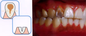 術前：虫歯によって、歯の色が変色しています。