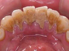 歯周病はプラーク（歯周病菌）が大きな原因です